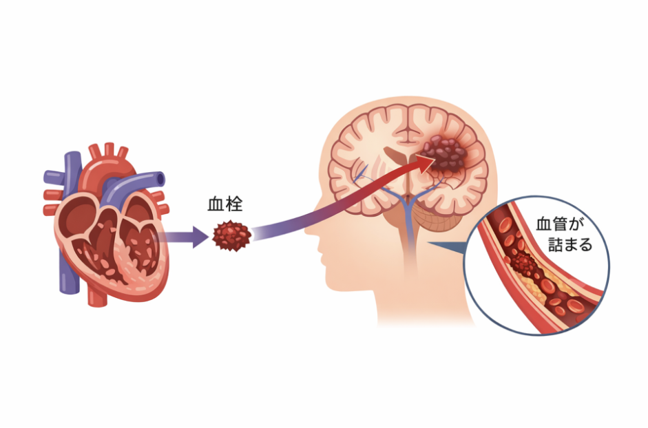 心原性脳塞栓とは?突然起こる脳梗塞の正体を脳神経外科医の視点で解説